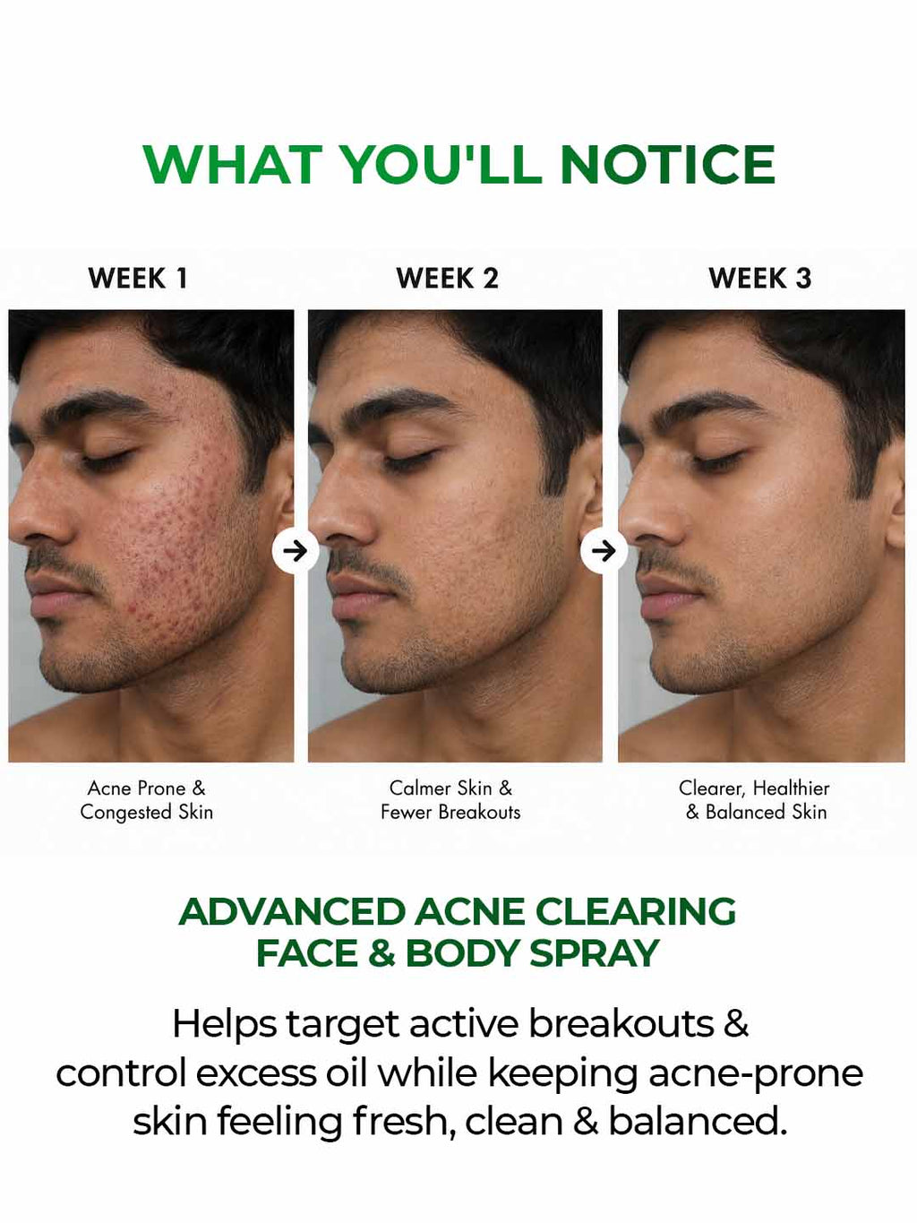 Body Acne Spray with Salicylic Acid, Benzoyl Peroxide & Zinc PCA | For Back & Body Breakouts | Fast-Drying 360° Spray
